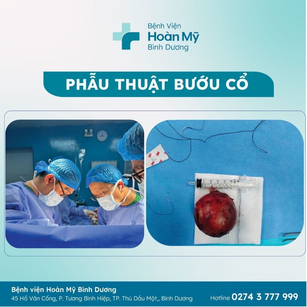 Phẫu thuật bướu cổ cho bệnh nhân nữ 21 tuổi tại Bệnh viện Hoàn Mỹ Bình Dương