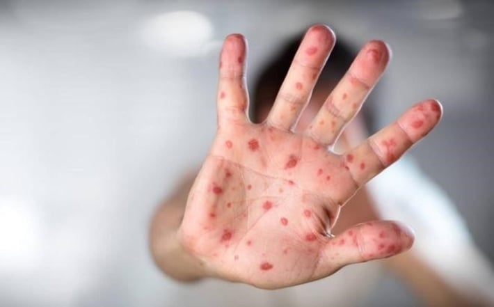 Bệnh tay chân miệng: nhận biết, chăm sóc và phòng ngừa